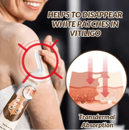 Sumifun - Vitiligo Removal Cream