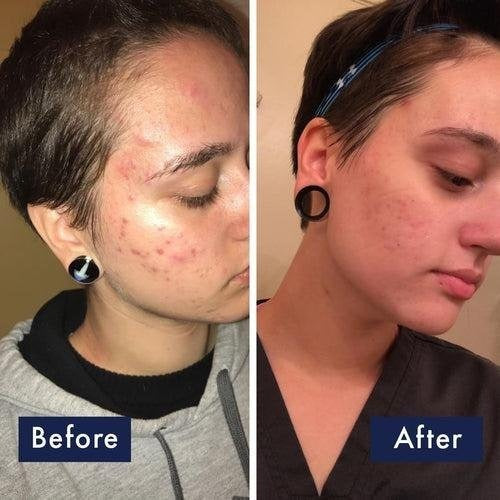 PanOxyl - Acne Foaming Wash